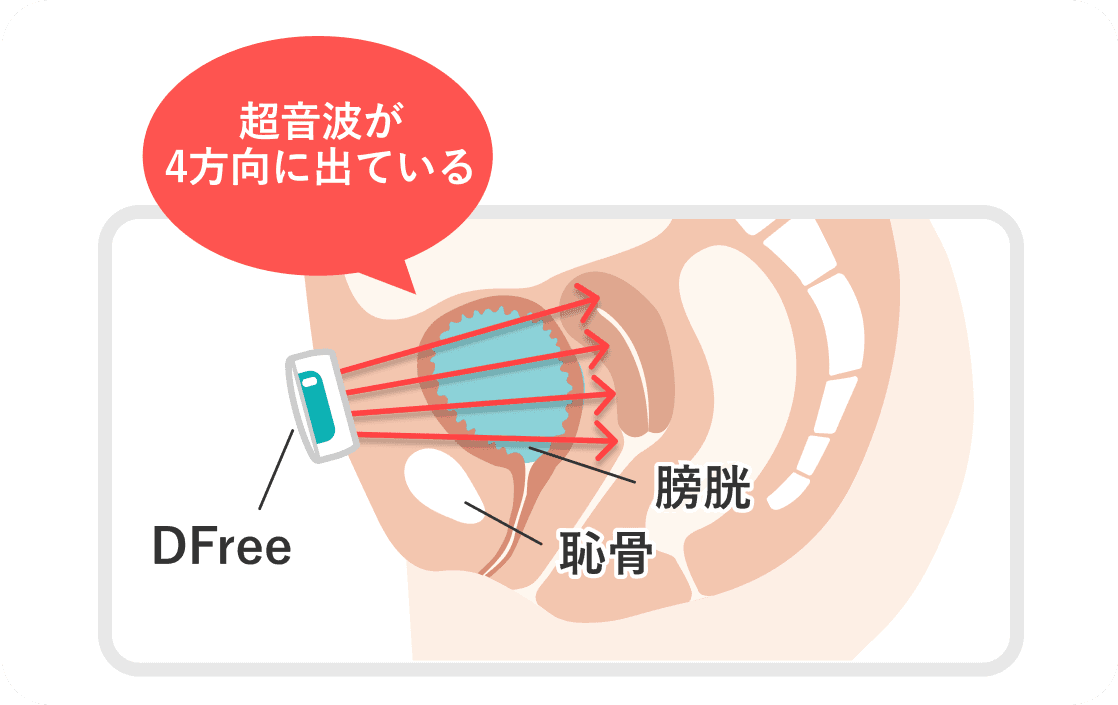 膀胱の状態をモニタリング